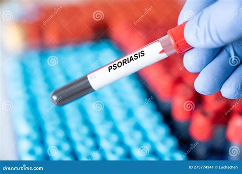 scratch test for psoriasis|blood test for psoriasis.